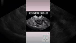 Recuento de folículos Un estudio mediante ecografía transvaginal [upl. by Bain]