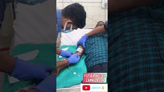 Fistula needle cannulation  dialysis needle cannulation  fistula needle insertion video [upl. by Anitnegra837]