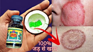 दाद खाज खुजली कि सिर्फ 2 दिन में छुट्टी कर देगा  fungal infection treatment  dad khaj khujli ilaj [upl. by Maurilia783]