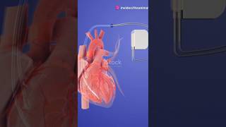 The Evolution of the Pacemaker pacemaker heart medicalinnovations hearthealth medivalhistory [upl. by Ainotal]