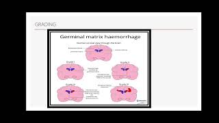 Intraventricular haemorrhage ivh germinal matrix hemorrhage Periventricular leucomalcia [upl. by Musihc]