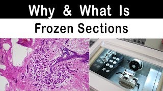 Why and what is Frozen Sections [upl. by Ahsenit]