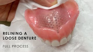 Relining a Loose Denture  Full Process [upl. by Pandora]