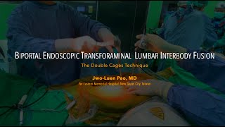 Paos Biportal Endoscopic Transforaminal Lumbar Interbody Fusion BETLIF using Double Cages [upl. by Joao]