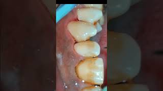 Scaling and Air Polishing using Prophymate teeth teethcleaning teethwhitening [upl. by Sardse]