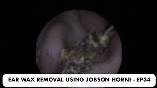 EAR WAX REMOVAL USING JOBSON HORNE  EP34 [upl. by Ruthe582]