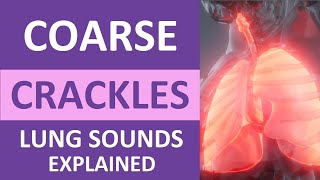 Coarse Crackles Lung Sounds Audio Causes Auscultation Nursing NCLEX Review [upl. by Brodsky142]