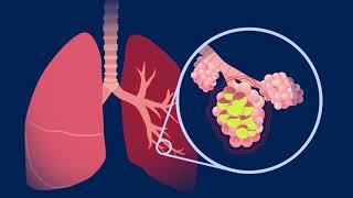 Understanding Pneumococcal Pneumonia [upl. by Yrelbmik]