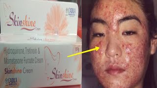 Skin Shine CREAM SIDE EFFECTS के कारण  Reason of SIDE EFFECTS  How to Remove side effects  Hindi [upl. by Hall]