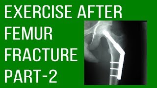 Exercise After Femur Fracture Part2 [upl. by Novets898]