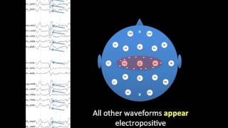 EEG Montages [upl. by Akinam]