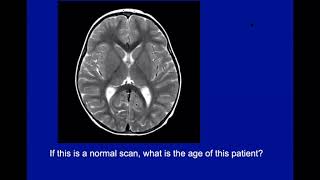 Imaging of Bilateral Basal Ganglia and Thalamic Diseases [upl. by Atrim]