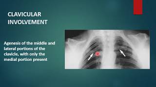 CLEIDOCRANIAL DYSPLASIA  Xray  Radiology [upl. by Trefler304]