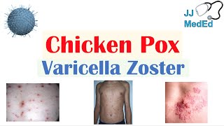 Chickenpox  Varicella Zoster Virus  Pathogenesis Signs and Symptoms Diagnosis and Treatment [upl. by Berke837]