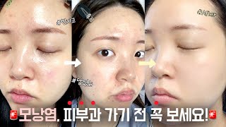 번지는 모낭염🔥 피부과 NO 모낭염 vs 여드름 구분법 관리법 모두 공개합니다 ㅣ HASOMY 하소미 [upl. by Daus]