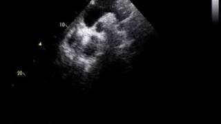 coarctation of the aorta and RHDmild mitral stenosis [upl. by Nnod123]