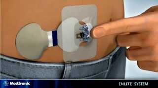 EN Inserting the Enlite Sensor with Paradigm® Veo™ insulin pump Paradigm® Revel [upl. by Letsirhc690]