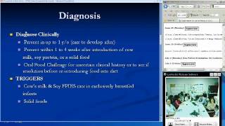 Food proteininduced enterocolitis syndrome FPIES [upl. by Neelyhtak]