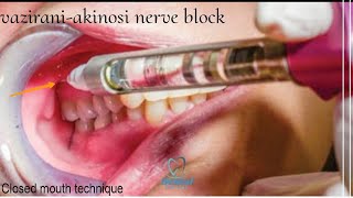 vaziraniakinosi nerve block technique  Local anesthesia for mandibular teeth [upl. by Latt]