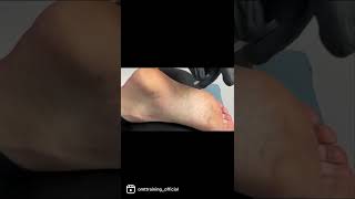 Acupuncture techniques for the foot [upl. by Nomolas]