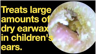 Treats large amounts of dry earwax in childrens earsear wax removal  ear cleaning  ASMR [upl. by Ellis]