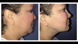 NECK LIPO CHIN LIPO AMAZING LIVE BY DR THOMAS BARNES NEWPORT BEACH COSMETIC SURGEON MUST SEE [upl. by Udall]