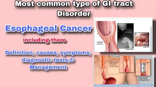 Understanding Esophageal Cancer  Symptoms Diagnosis and Treatment [upl. by Womack]