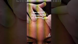 Electrolysis hair removal ￼￼at New skin NYC in Queens  haircare youtubeshorts nyc youtubeshort [upl. by Annua796]