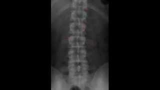 Lumbar Spine Radiology Tutorial [upl. by Tim]