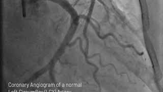 Coronary Angiogram of a normal Left Circumflex LCX Artery [upl. by Allveta24]