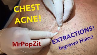 Chest congestionblackheads whiteheads ingrown hairs Multiple plugs extracted patient left happy [upl. by Axe24]