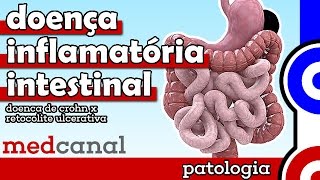 Doença Inflamatória Intestinal  PATOLOGIA [upl. by Ainafetse]