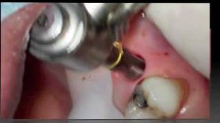 Implant flapless surgery [upl. by Mhoj]