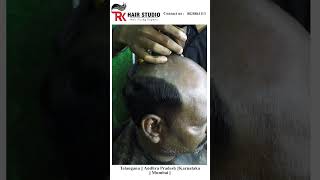 hair patch Kitne din Chalta haihairpatch hairreplacment confidenceboost hair beauty hairstyle [upl. by Kalam]