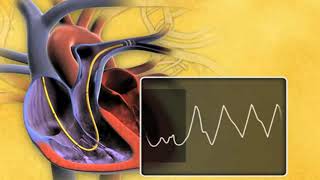 Swan Ganz Thermodilution Pulmonary Artery Catheter rdyUjTB4vaU mpeg4 [upl. by Waechter637]