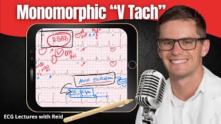 Monomorphic Ventricular Tachycardia VT EKG  ECG Lecture [upl. by Ytineres797]