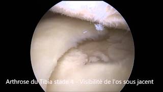 Arthrose du tibia  knee arthritis  Docteur Mourad KASSAB Paris Frace [upl. by Arihsan]