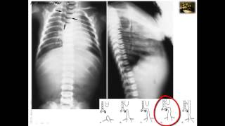 Embryology of Congenital Anomalies of the Foregut 1 [upl. by Strenta]