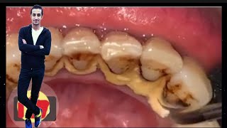 tartar removal from teeth [upl. by Niwroc]