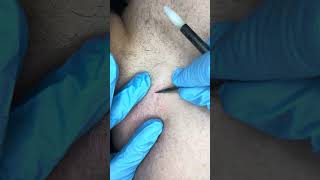 Watch electrolysis Back hairs permanent hair removal [upl. by Encratia]