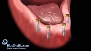 Patient Treatment Videos Overdenture [upl. by Pan981]