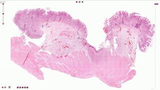 Peptic Ulcer  Histopathology [upl. by Sunderland]