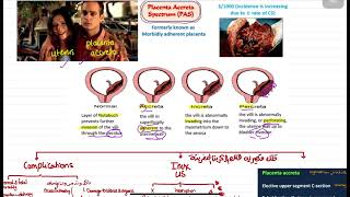 Placenta accreta [upl. by Nyleahs992]