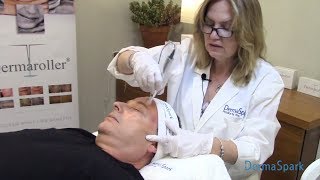 Dermaroller® Microneedling  eDermaStamp Training Video [upl. by Marchal]