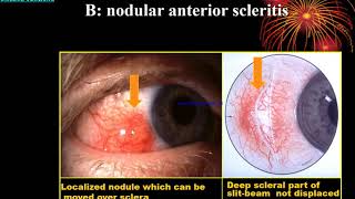 Sclera Lect By Dr Abdul Basir Safi 1 [upl. by Anytsirk661]