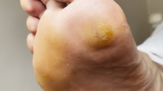 Professional treating cracked  Cracked treatment amp Callus removal  ASMR PART 1 [upl. by Wallas]