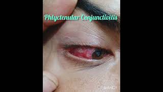 Phlyctenular Conjunctivitis department of Ophthalmology conjunctivitis [upl. by Essilrahc]