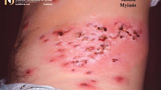 Squirming Larvae under my skin Graphic  African Insect Infection [upl. by Nemad]