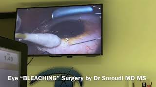 Eye Bleaching Surgery for Racial Melanosis Dr Ebbie Soroudi MD MS [upl. by Aihseit]