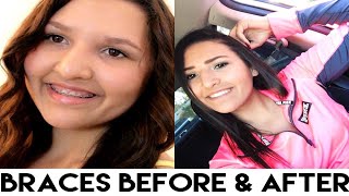 My Braces Experience Before and After  braces before and after [upl. by Tri]